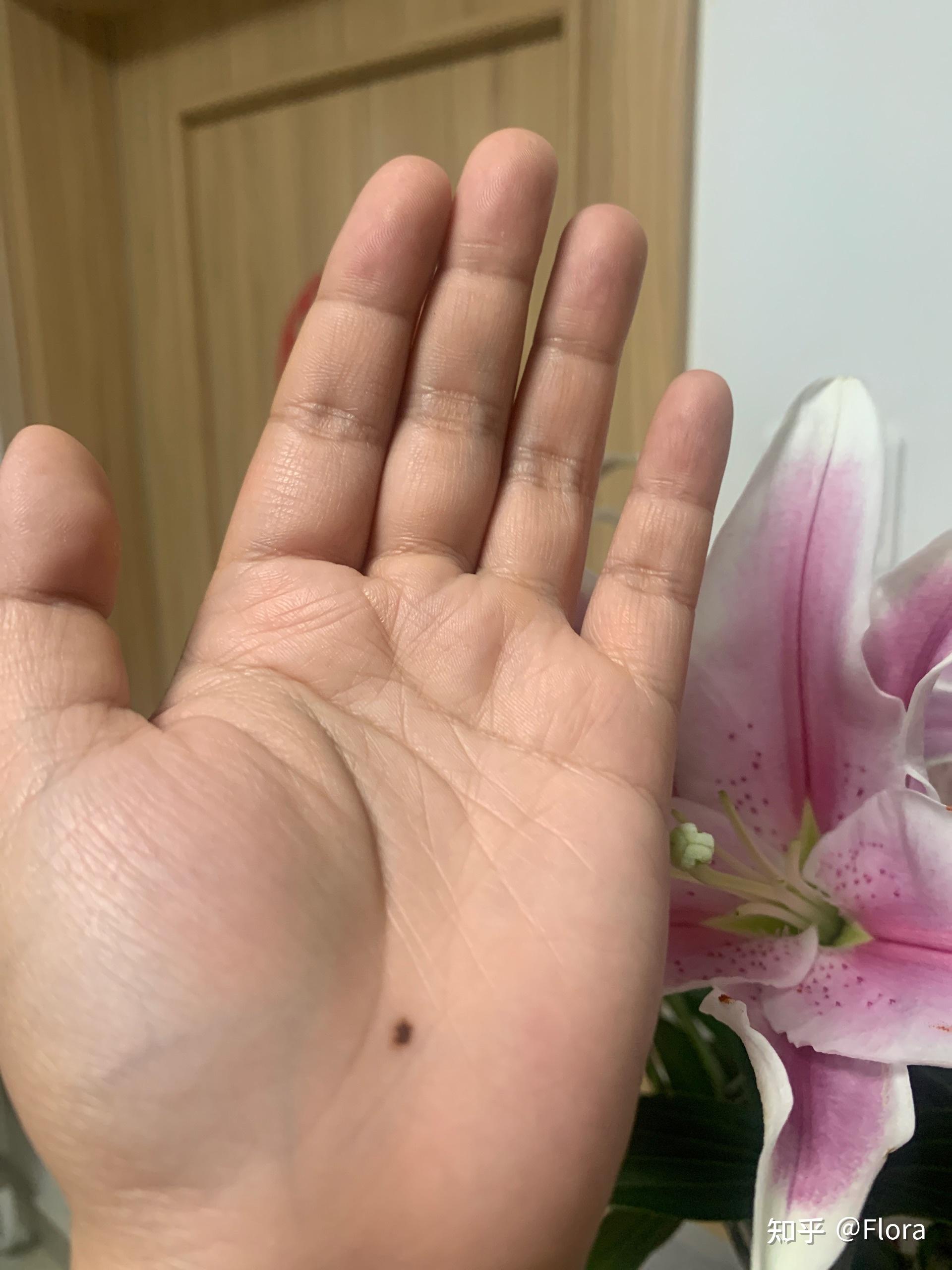 合和痣这个美丽的传说可以信吗