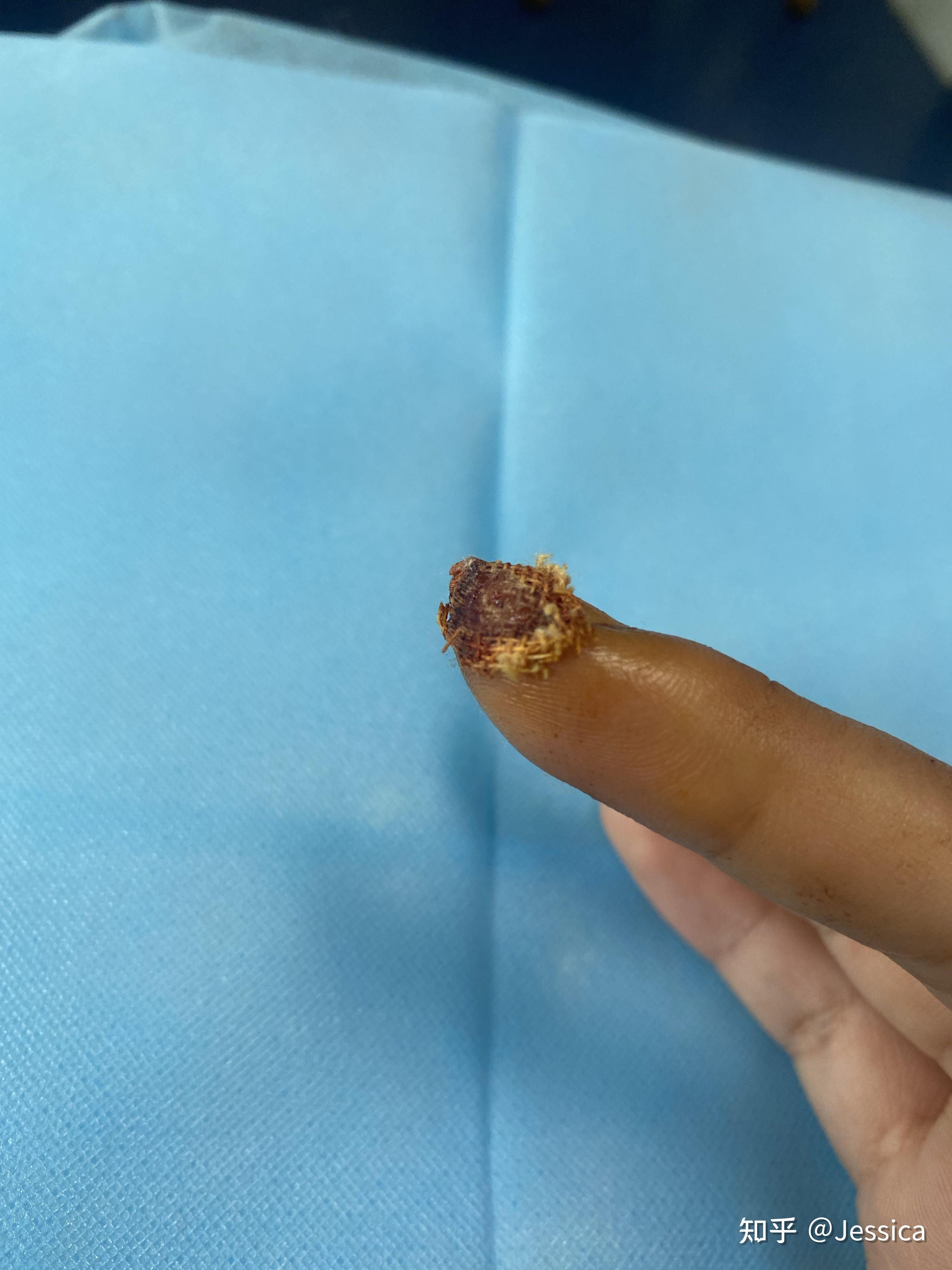 手指被割掉一块肉是什么体验? - 知乎