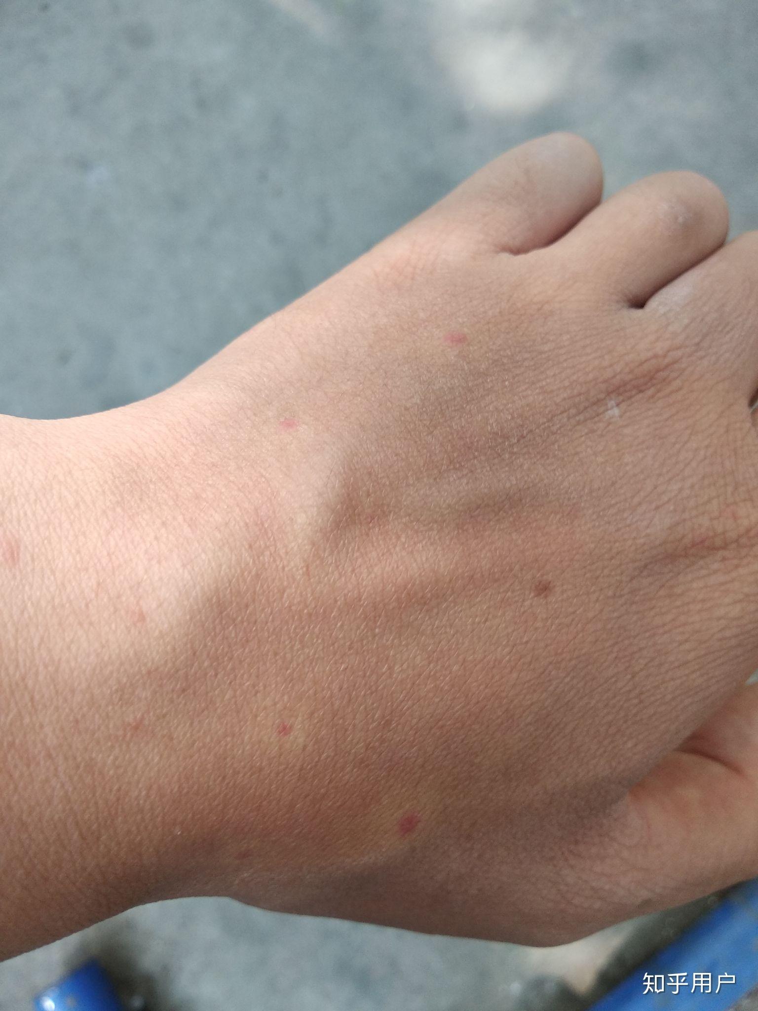同样是被蚊子咬,为什么有些人是一个大包,有些人是一个小红点? - 知乎