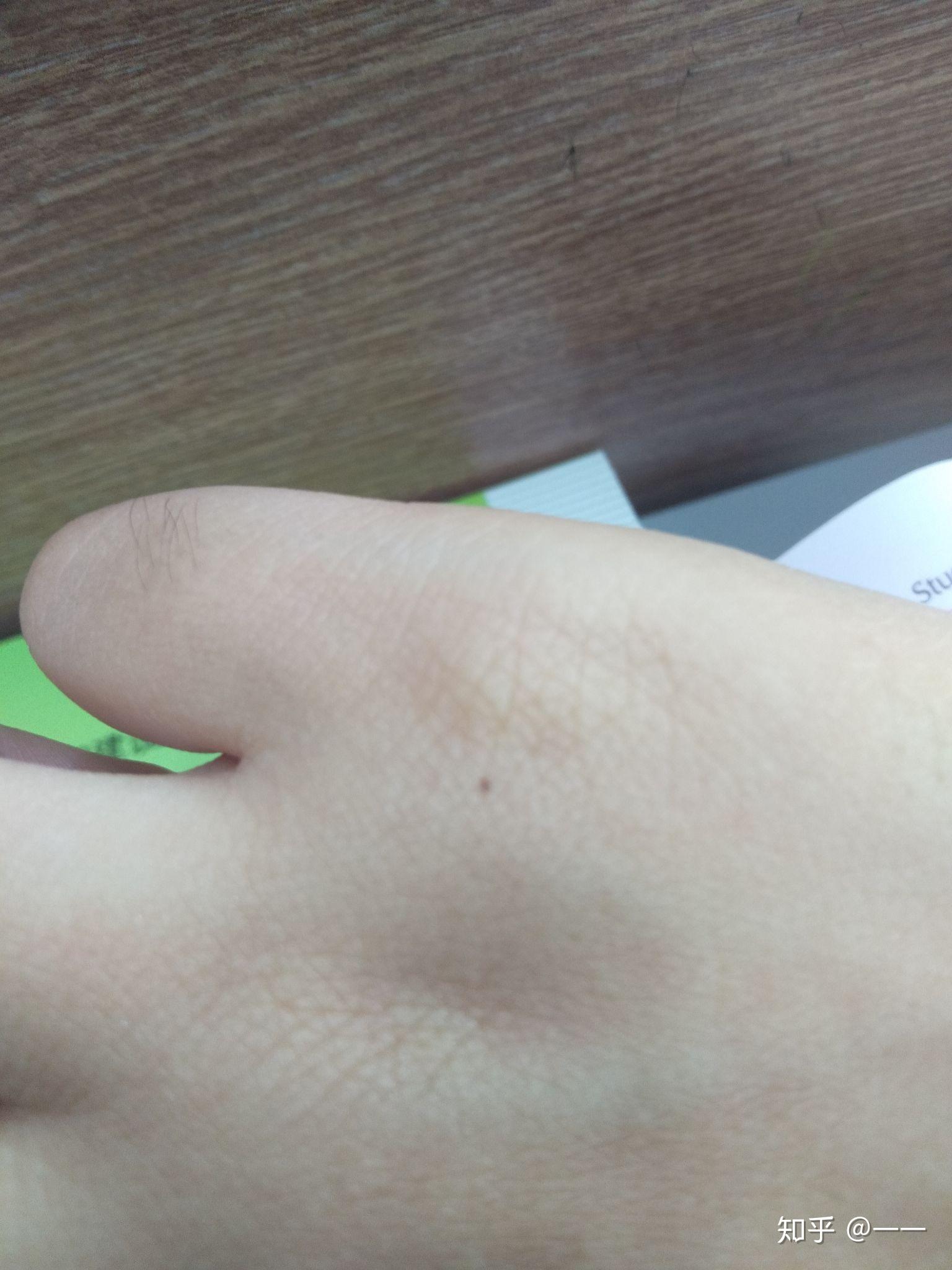 手指突然间长出一个痣会不会变成黑色素瘤实验室经常接触些生化物品