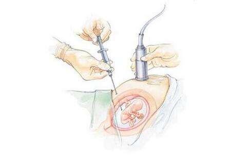 什么是绒毛穿刺