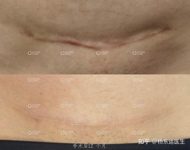 10.明显的剖腹产疤痕应该怎么治疗? - 知乎