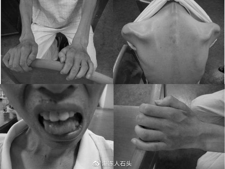 渐冻症的早期症状即运动神经元病的症状渐冻人症是什么病