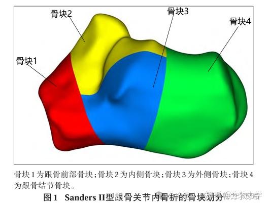 跟骨微创锁定接骨板联合螺钉辅助固定治疗Sanders Ⅱ型跟骨关节内骨折的三维有限元分析 - 知乎