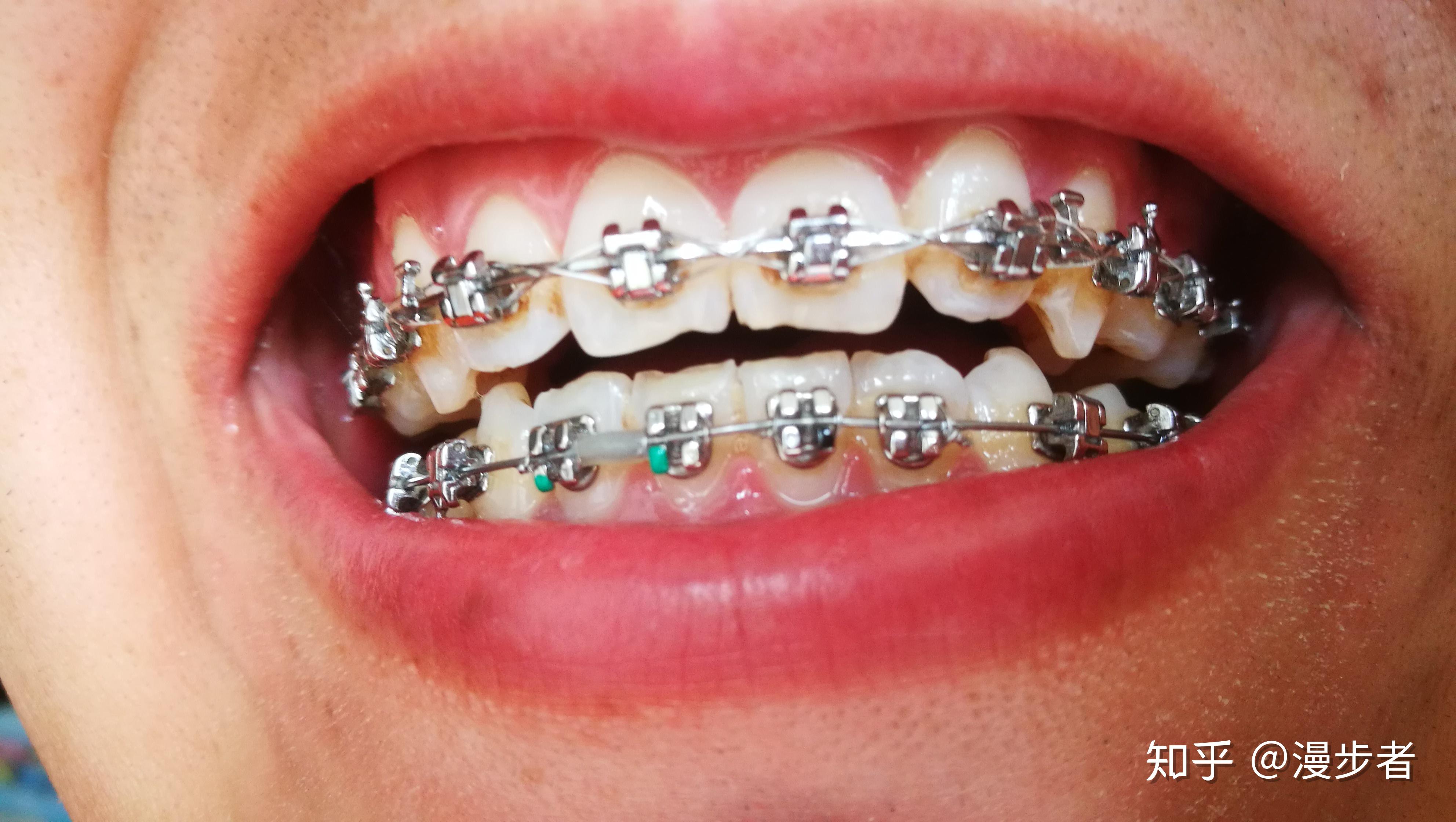 正畸用的进口的自锁托槽和国产的自锁托槽有什么区别?