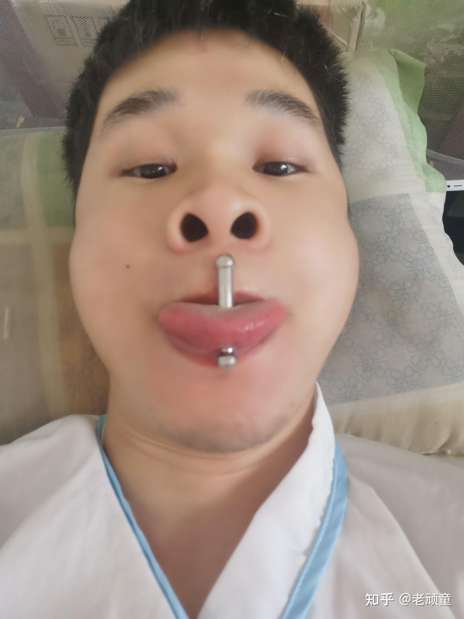 有没有打过舌钉的姐妹告诉我发炎是什么样子的