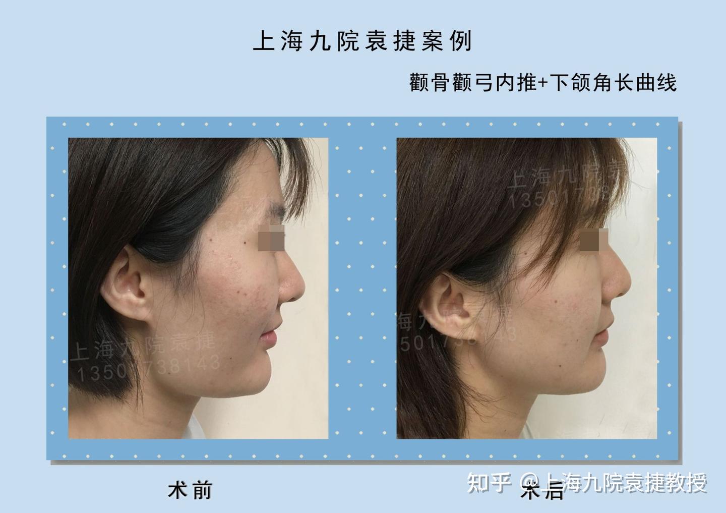 颧骨颧弓内推+下颌角截骨案例 - 知乎