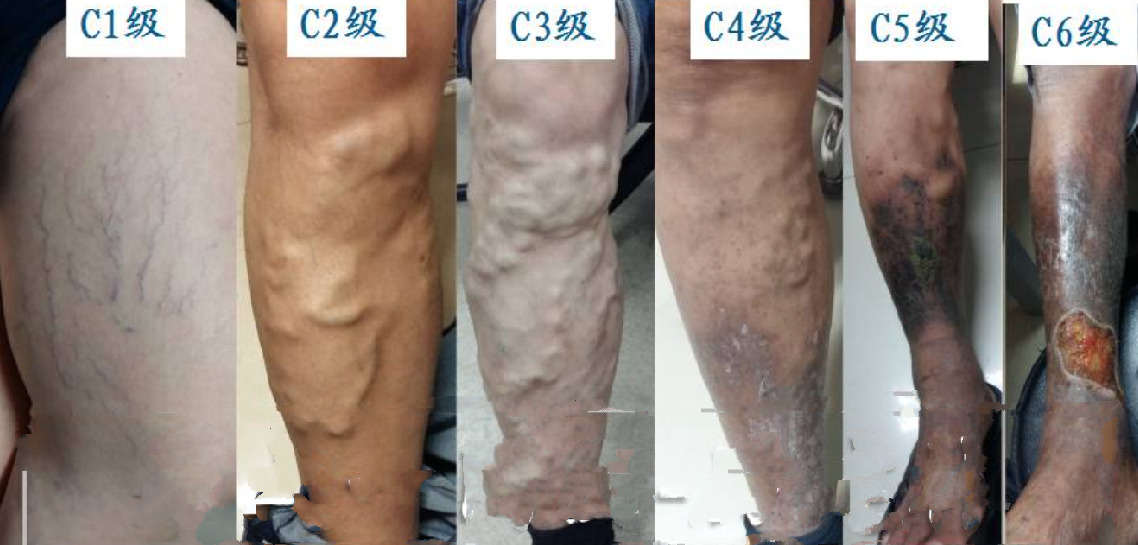 靠谱!小腿静脉曲张怎么治疗?"原来有用"-第1张图片-杰丰网