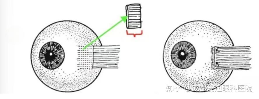 眼球斜視手術NGO水針刀 3D 美兆診所金門