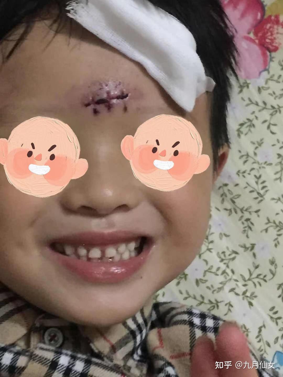 宝宝脸上伤口缝了六针,怎么护理才能不留疤 