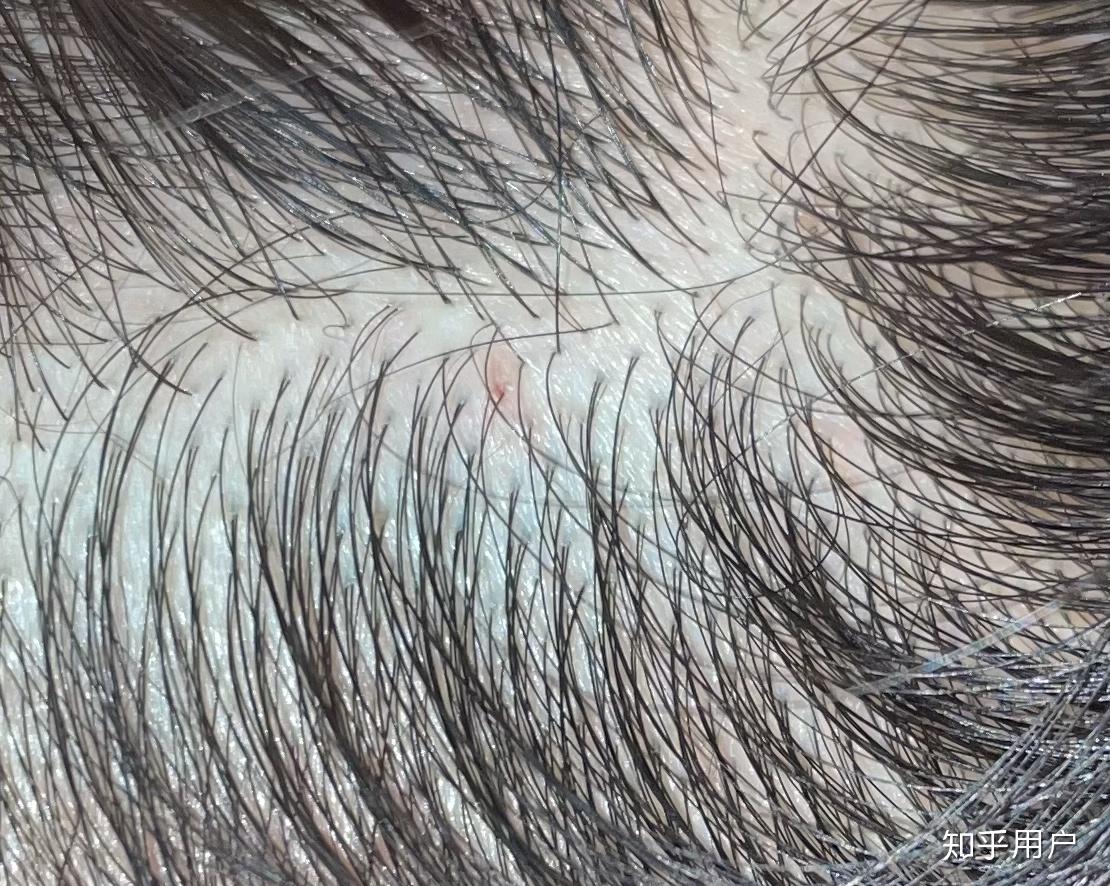 请问得了头部脂溢性皮炎经常扣那些小疙瘩会怎么样