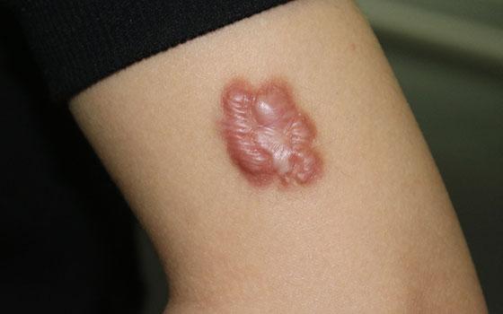 疤痕疙瘩在短期内能治好吗