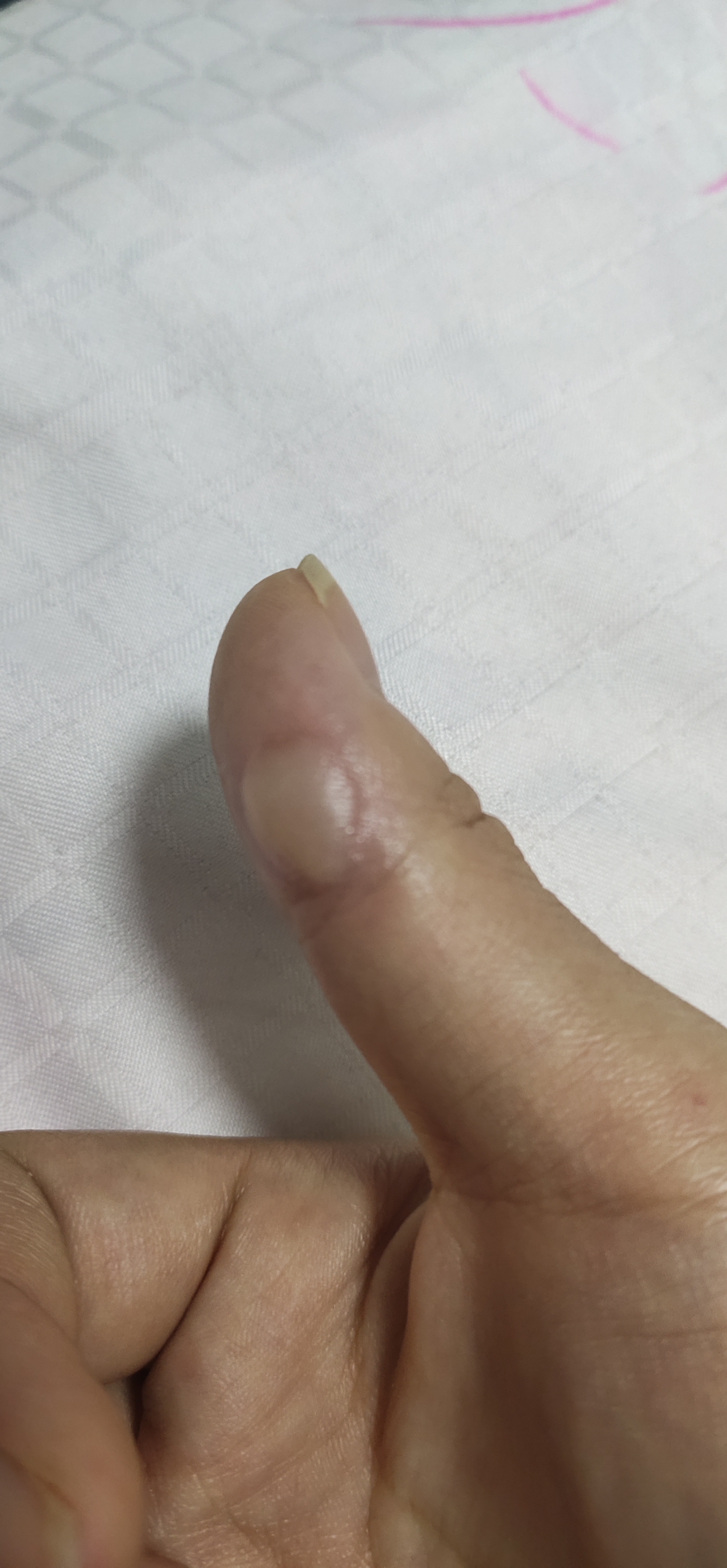 手指被油烫了怎么办? - 知乎