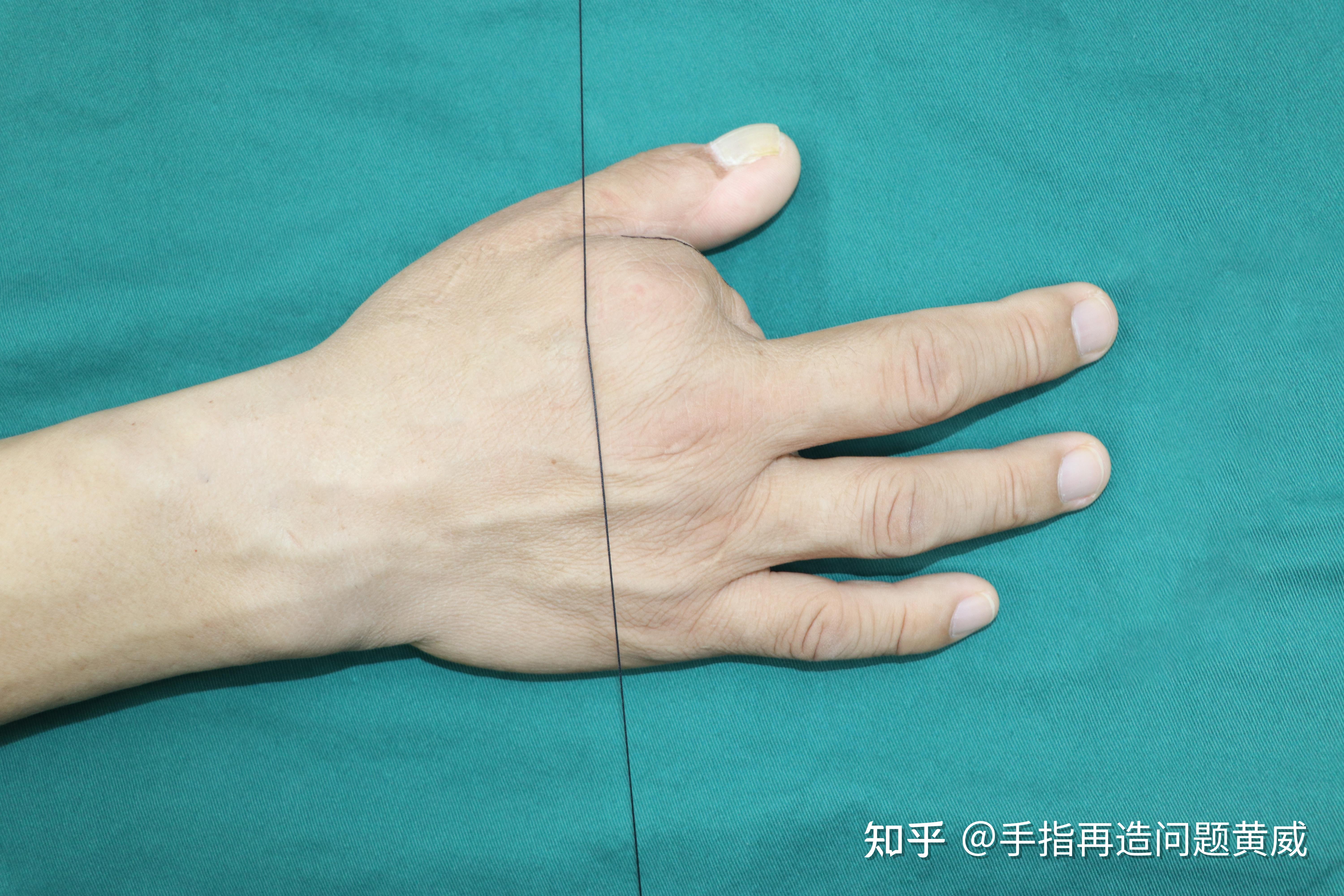 先天性手指缺损畸形怎么修复?可以做手指再造吗? - 知乎