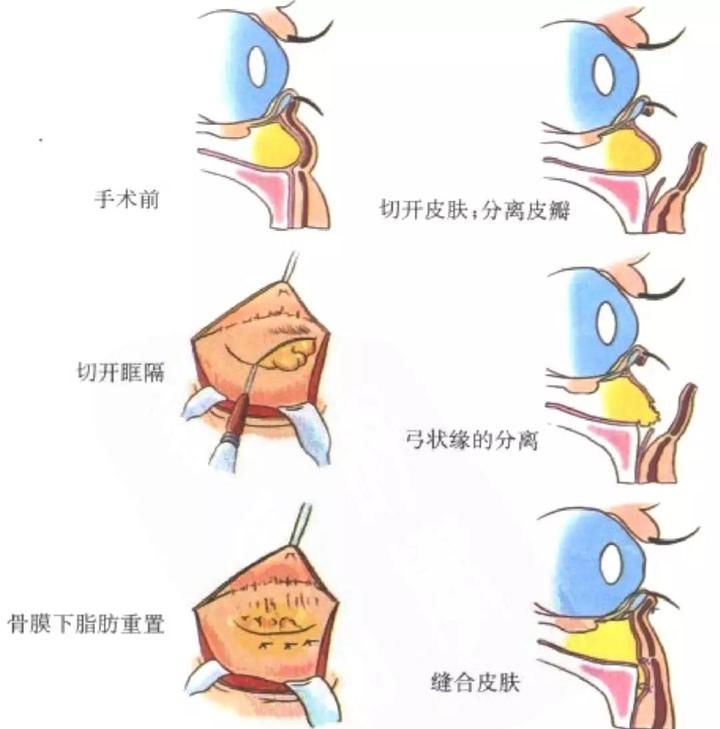 填充泪沟丨眶隔脂肪释放比脂肪移植，玻尿酸填充泪沟好在哪里？ - 知乎