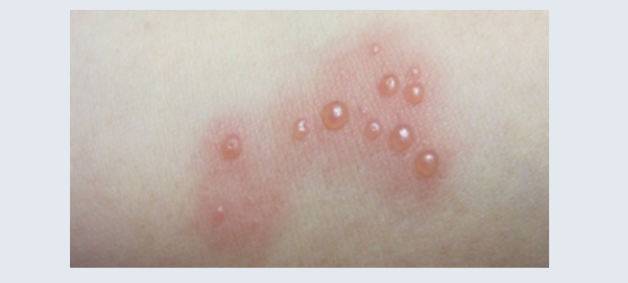 如何区分湿疹与干疮? - 知乎