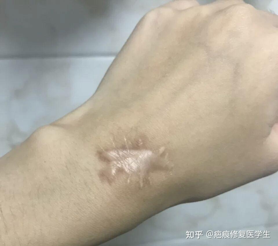 为什么有的人用祛疤膏有效果,有的人却没有效果? - 知乎