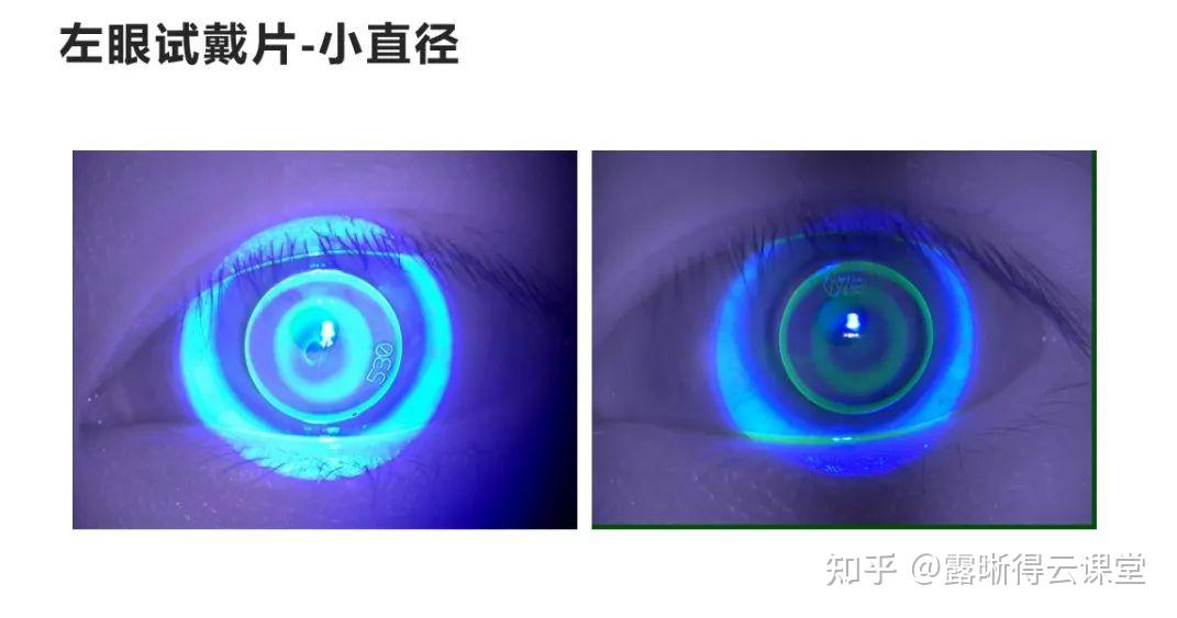 圆锥角膜的RGP验配及RGP临床效果分析（文字版） - 知乎