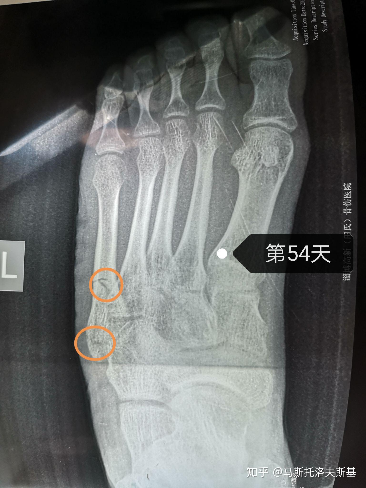 左脚第五跖骨骨折