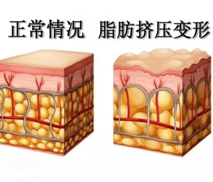百科都傻傻分不清的橘皮纹,到底有没有救? - 知乎