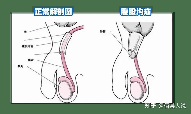 男性腹股沟位置图片图片