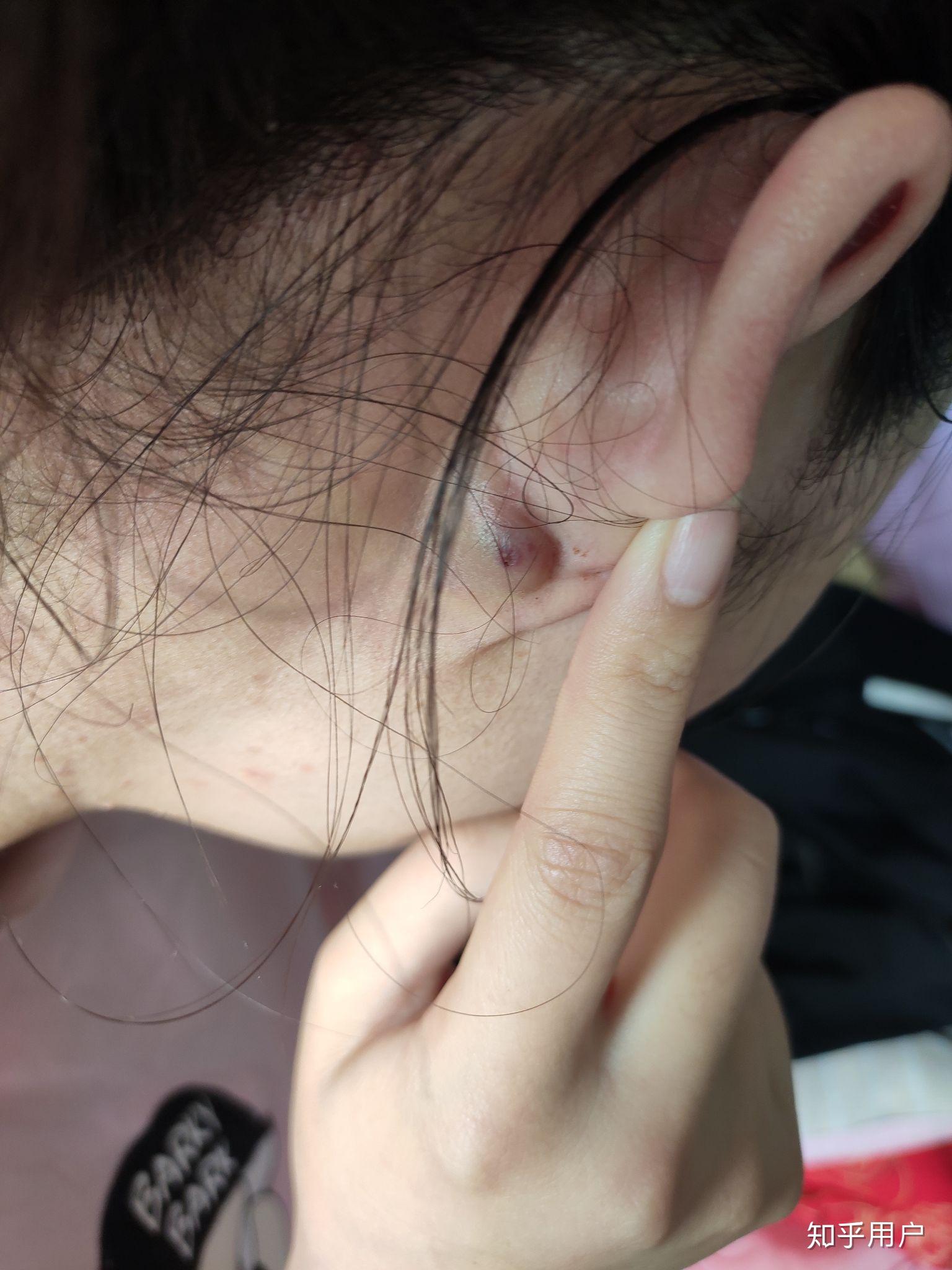 耳朵后面长了个包,是什么? - 知乎