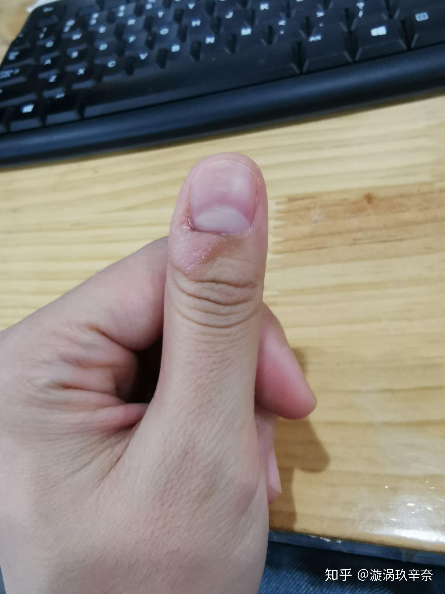 克制不住的抠手指头是心理问题吗? - 知乎