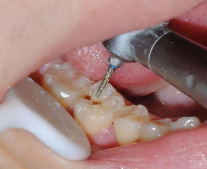 What is the Procedure for Filling a Cavity?