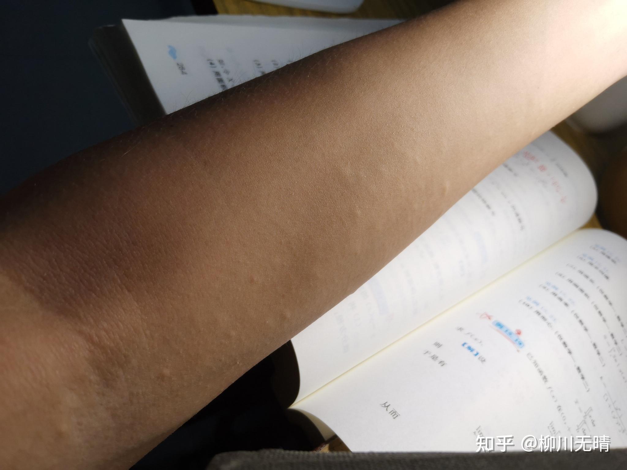 为什么运动时总起鸡皮疙瘩(为什么运动时总起鸡皮疙瘩呢)