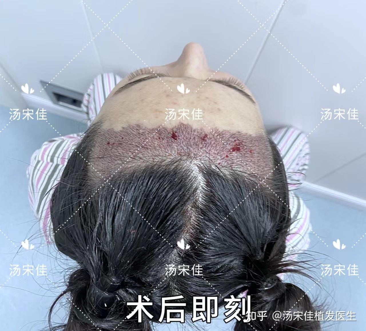 女性发际线植发1年,2500毛囊单位 - 知乎