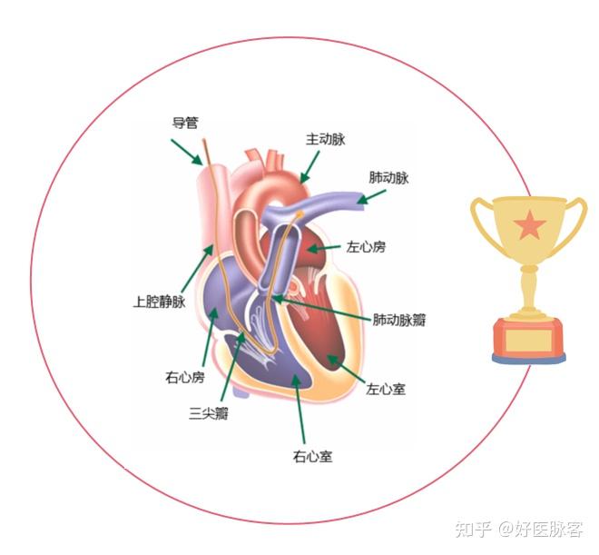 什么是右心导管检查 ？ 知乎 