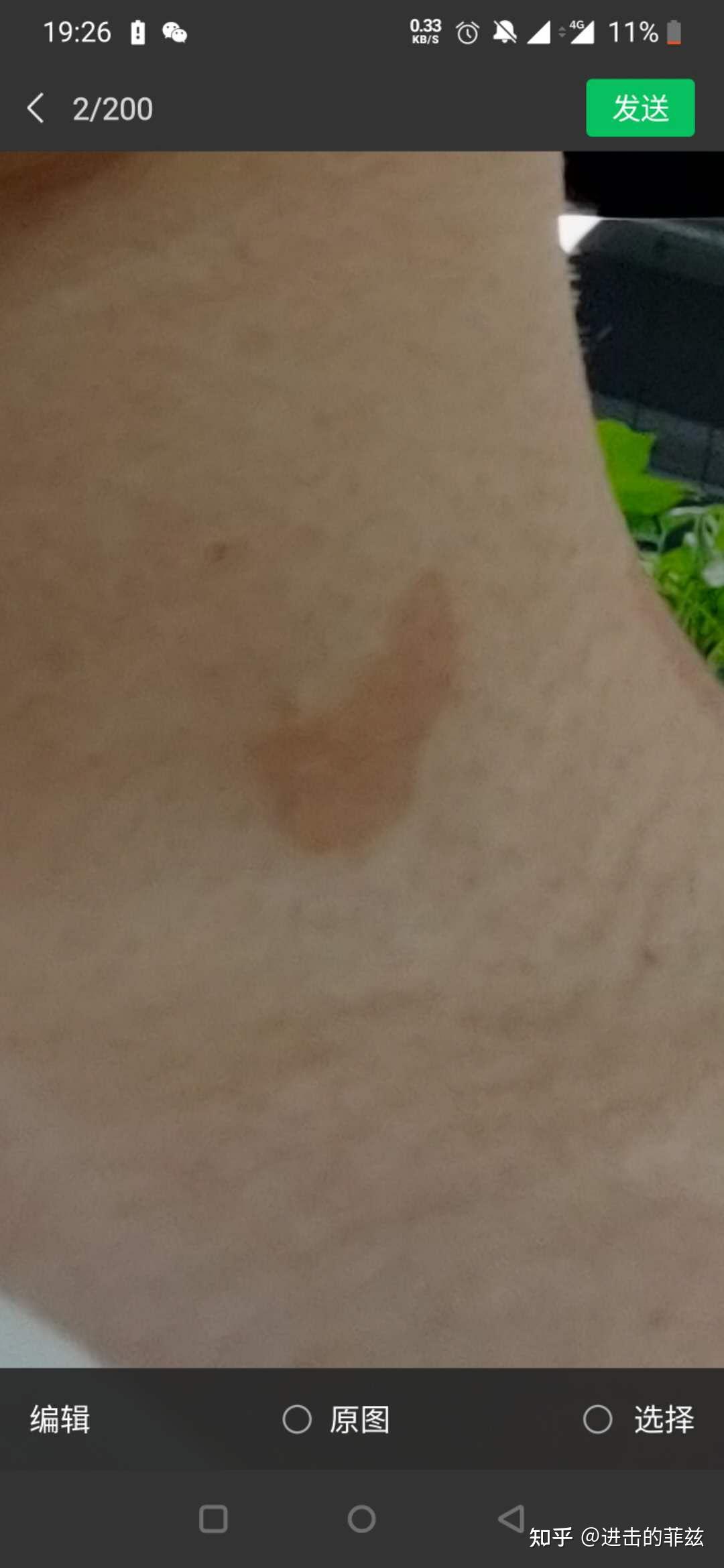 汗斑跟了我好几年了,以前一直都是在后背,现在蔓延到手臂上了