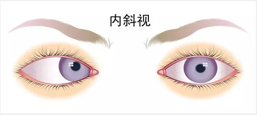 眼科专家讲解什么是内斜视 - 知乎