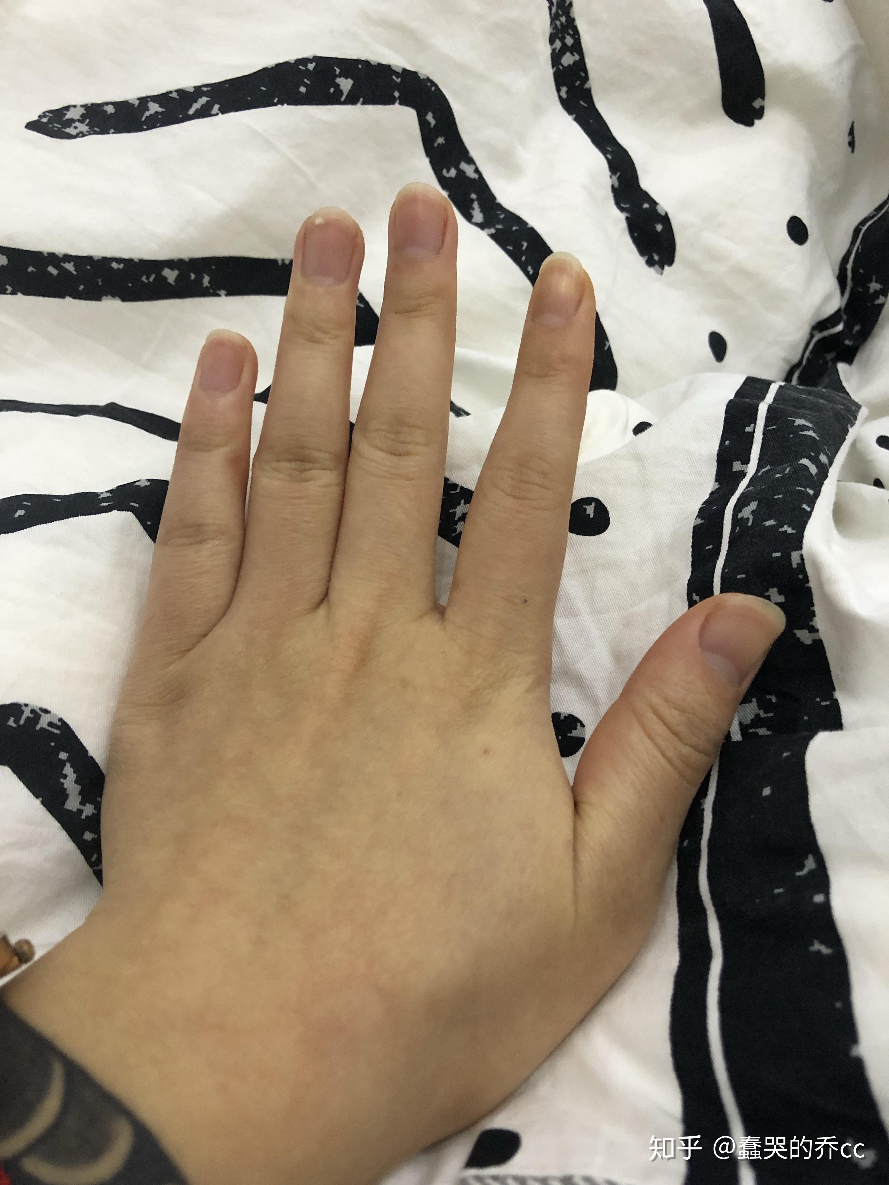 被冻疮冻过的手很黑怎么变白? - 知乎