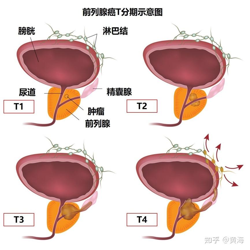 前列腺癌根治术后病例报告怎么看? - 知乎