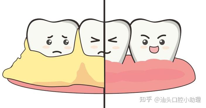 牙龈退缩能通过洗牙恢复吗?解答来了 - 知乎
