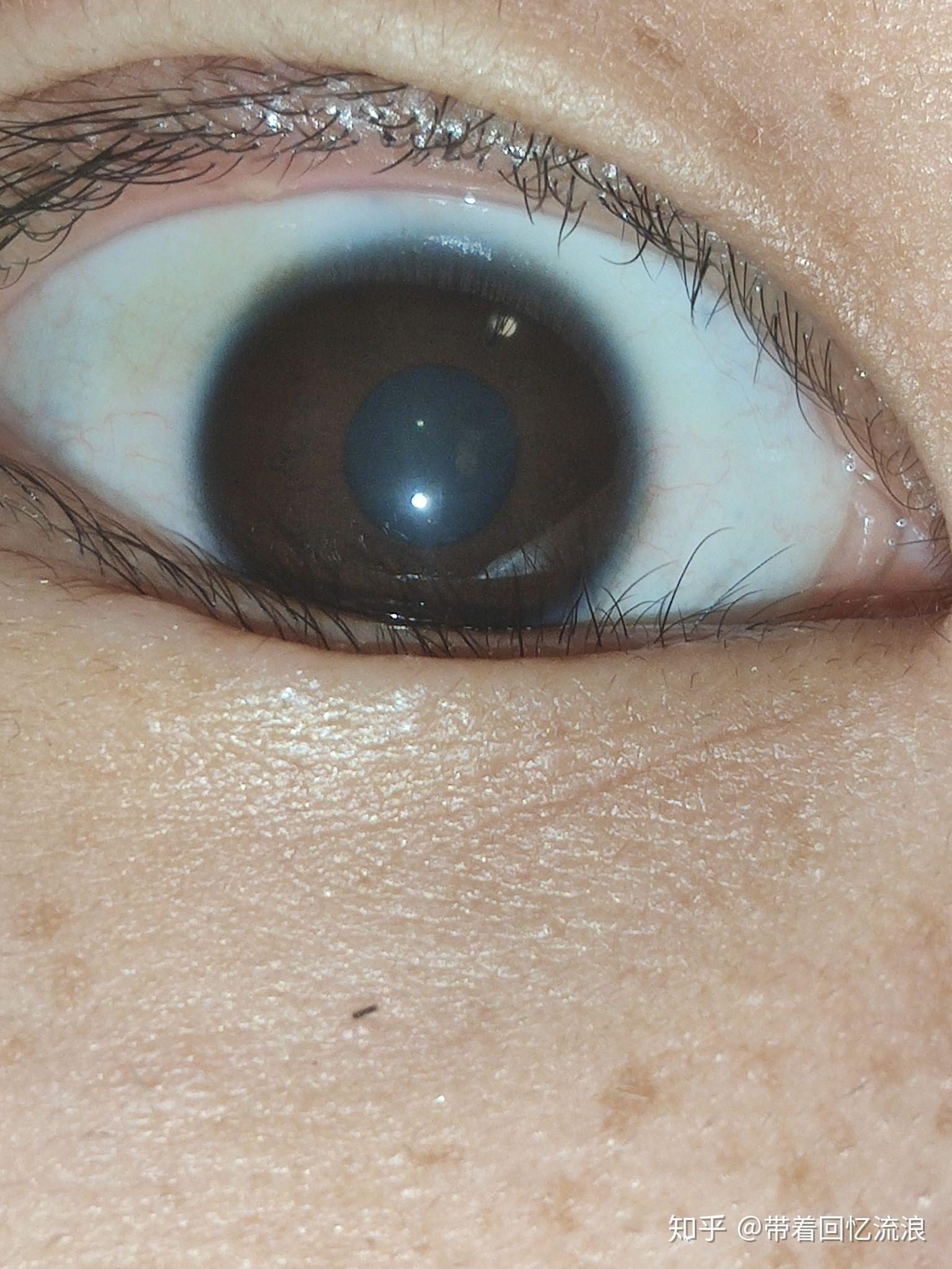 眼外角有点疼照了一下镜子发现眼球有点黄色的,而且眼黑上有的地方没