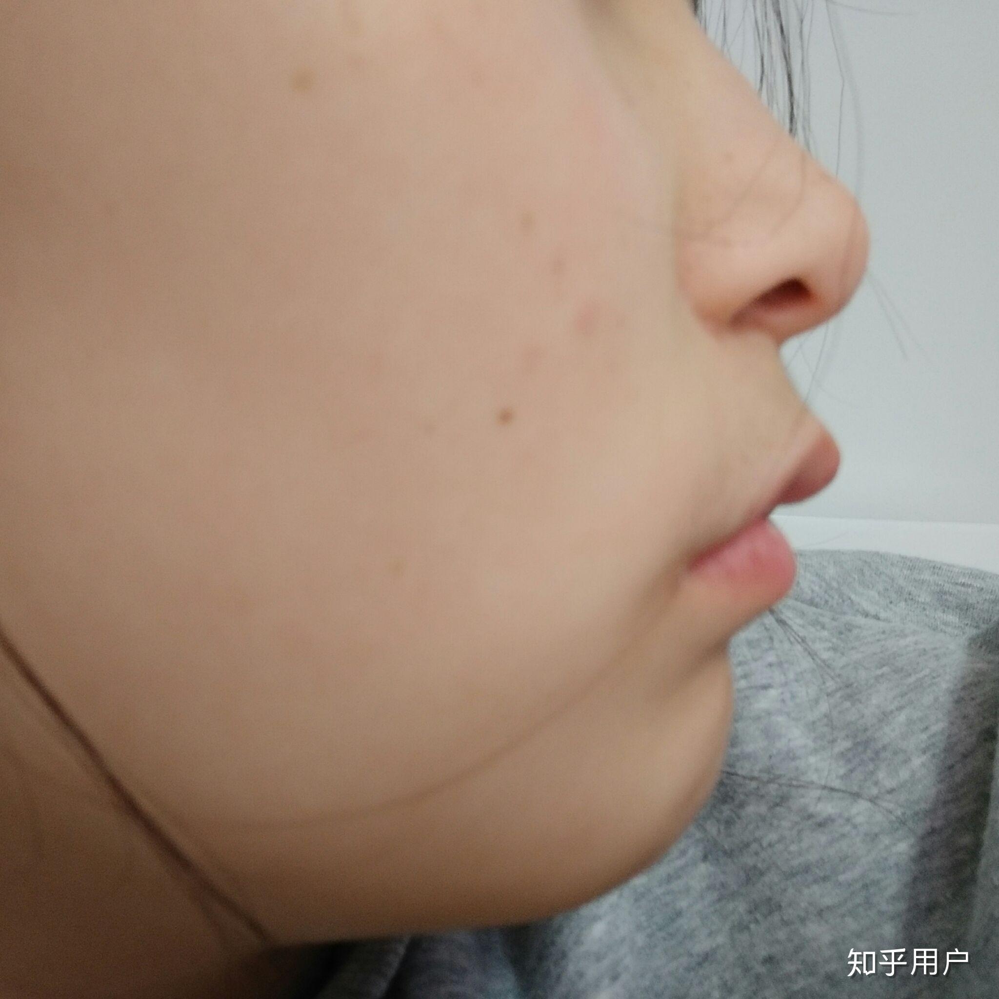 上嘴唇上翘上翻怎么办侧面看起来简直丑哭我