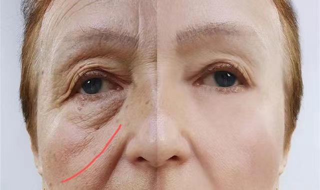 为什么苹果肌有一条凹陷?这一种方法能够轻松去除印第安纹