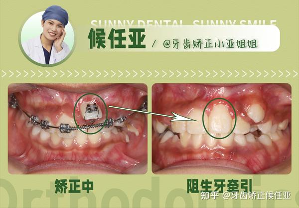 反合("地包天")的治疗主要有三个时期:乳牙期,替牙期和恒牙早期.