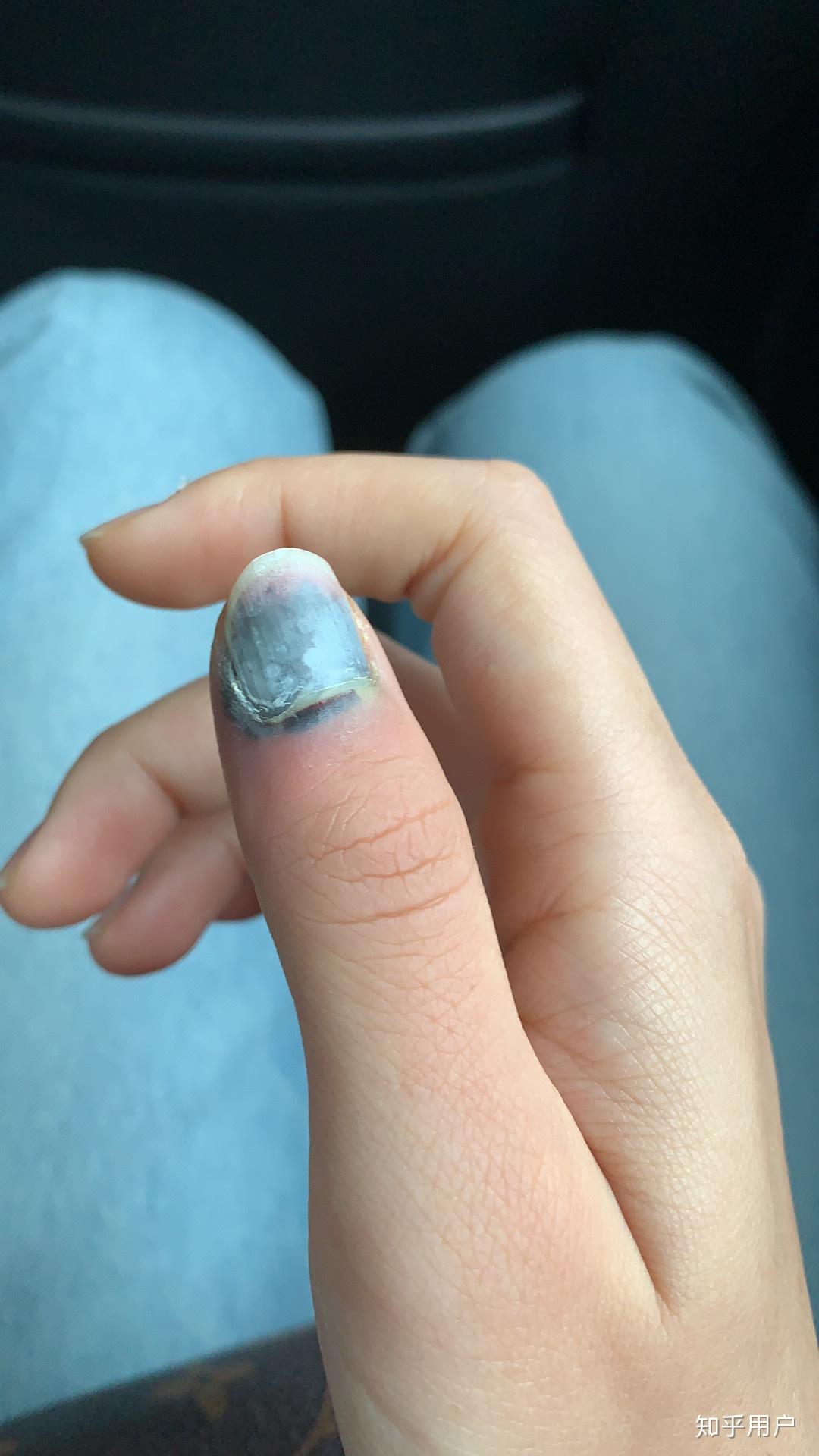 手指被门夹到飙泪是种怎样的体验