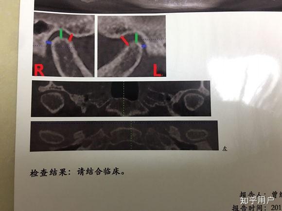 颞颌关节张口弹响，可复性关节盘移位，一定要做手术吗？ - 知乎