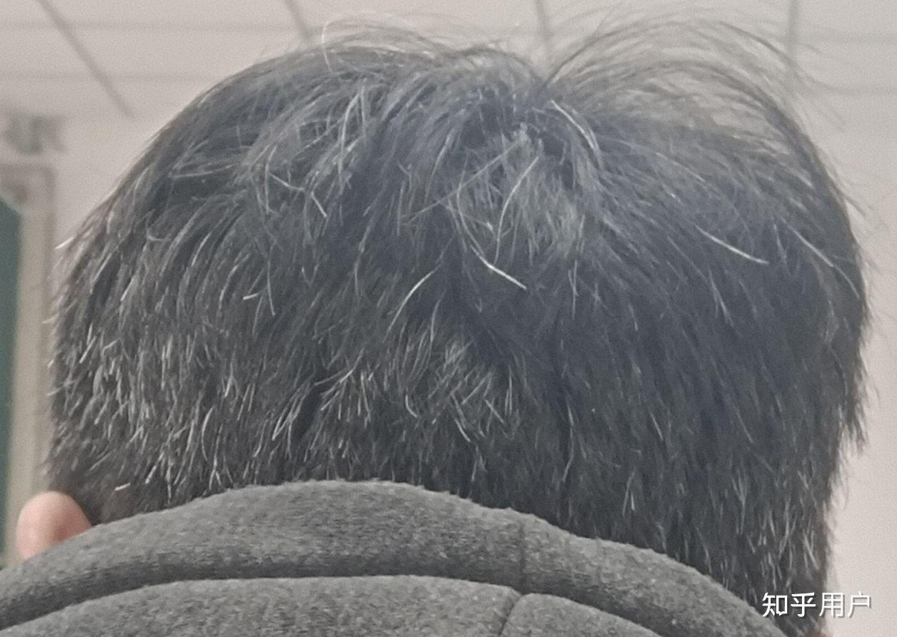 女生对少白头的男生怎么看? - 知乎