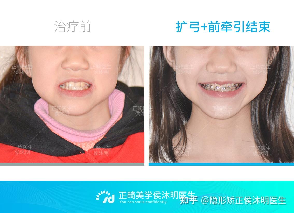 儿童牙齿矫正最佳年龄是什么时候？ - 知乎
