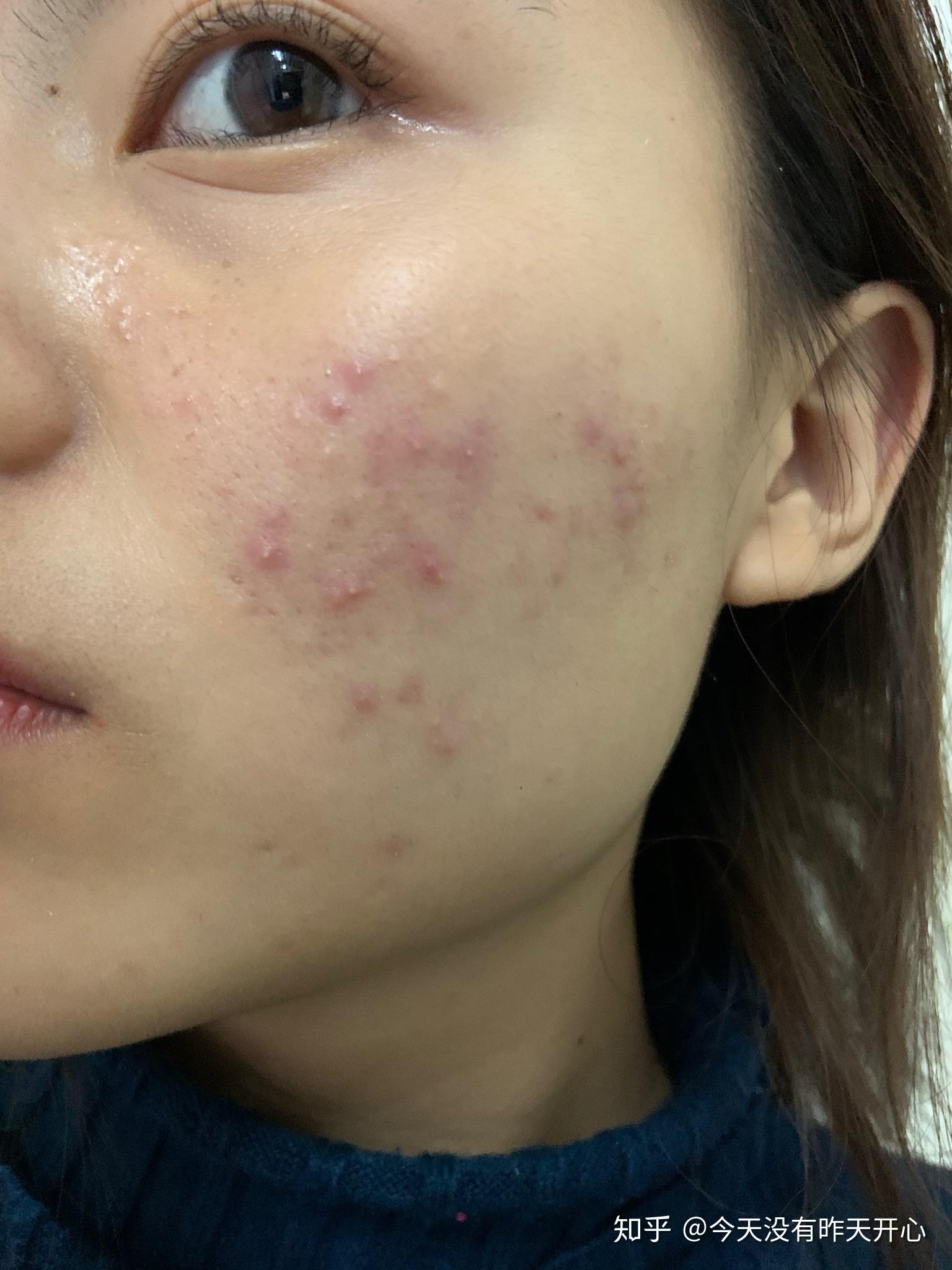 纪录一下战斗痤疮粉刺的过程