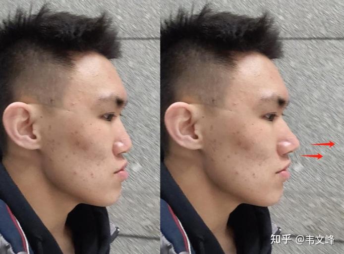 这样算低鼻梁吗~一直有容貌焦虑 这样的侧脸算怎样呢? - 知乎