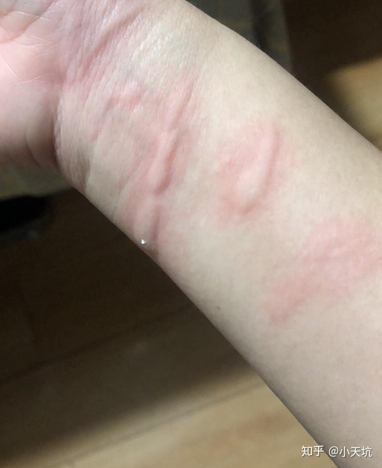 如果被兔子咬出血了就只把血擦干没消毒是话要怎么办啊血干了才想起来