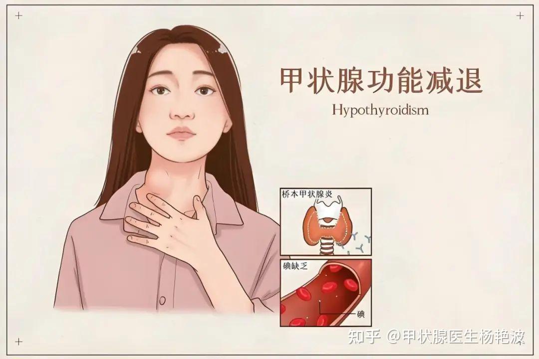 查出甲减，患者最关心的问题都在这里，一次性给你说清楚！ - 知乎