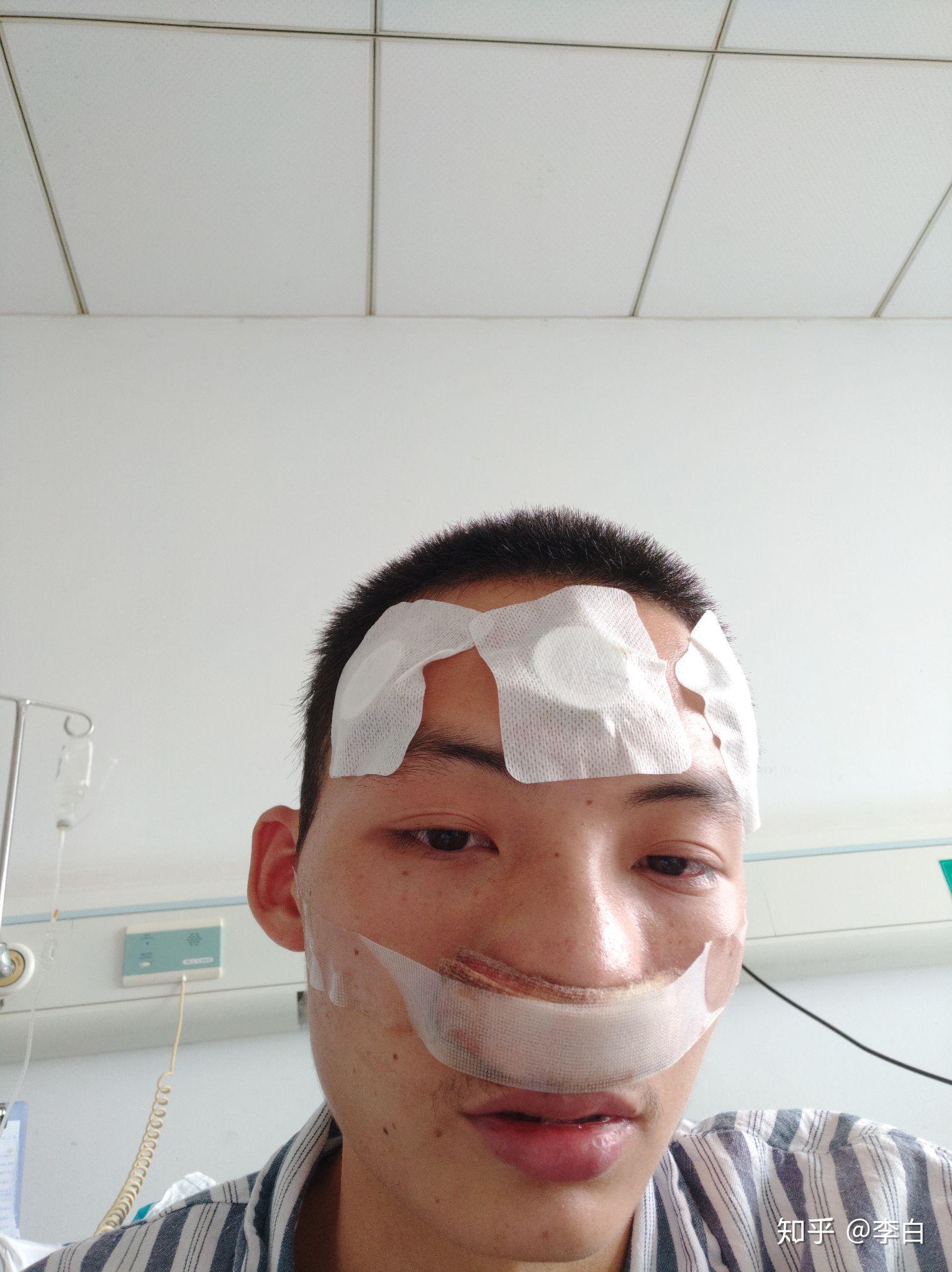 鼻窦炎手术是什么样的? - 知乎