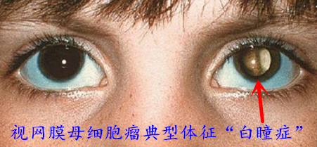 哪些情况会造成单眼失明?该如何避免? - 知乎